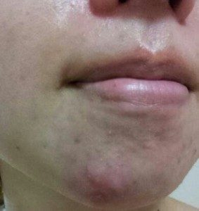 ニキビ 唇 唇のニキビの原因と対策