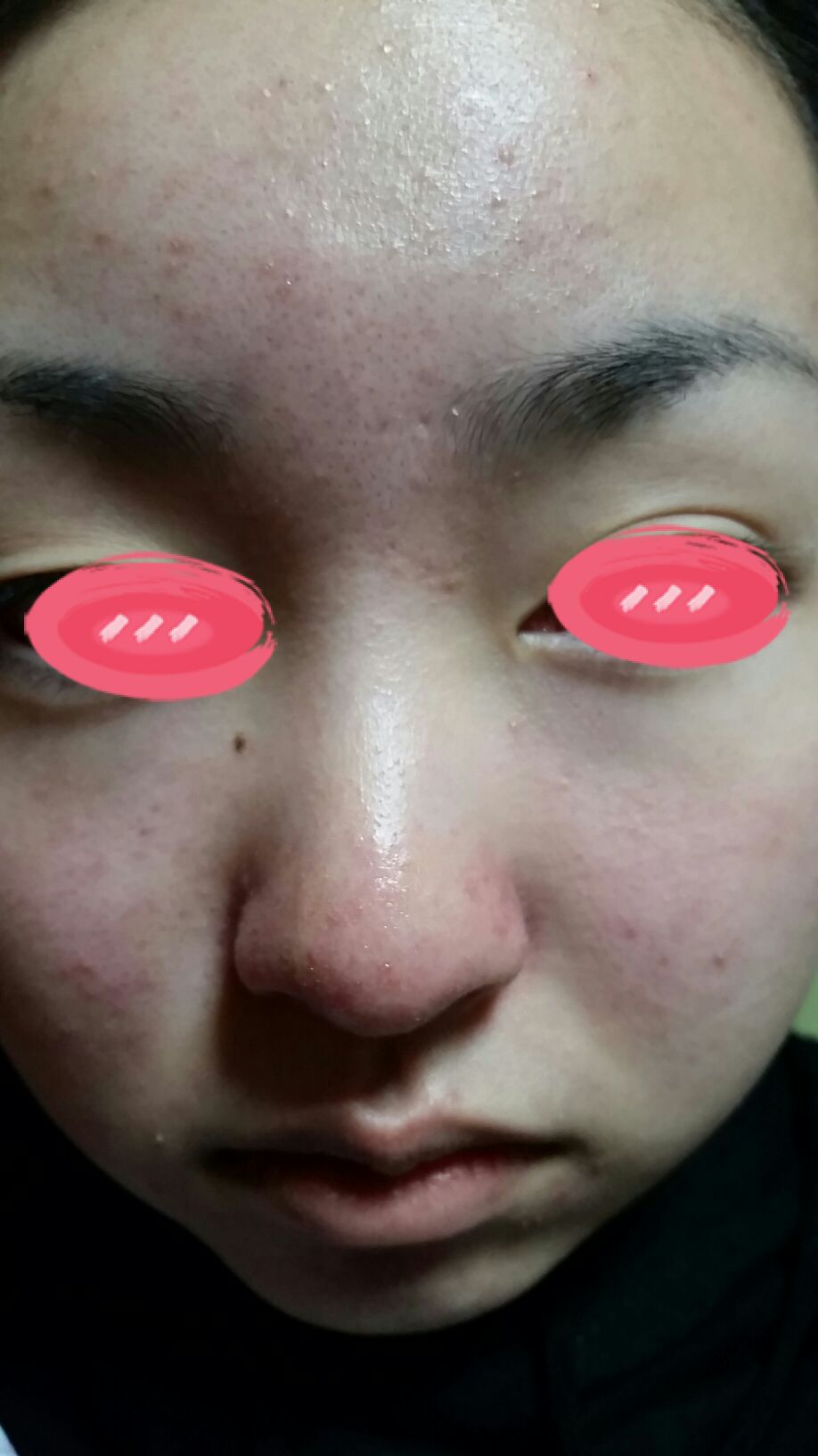 ニキビケア 体験談